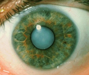 cataract